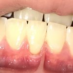 Top 4 des causes des maladies parodontales